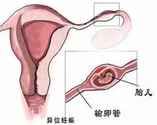 武汉代孕中介在哪里_武汉代孕合法流程_温馨国际助孕中心：哪种产妇要做会阴
