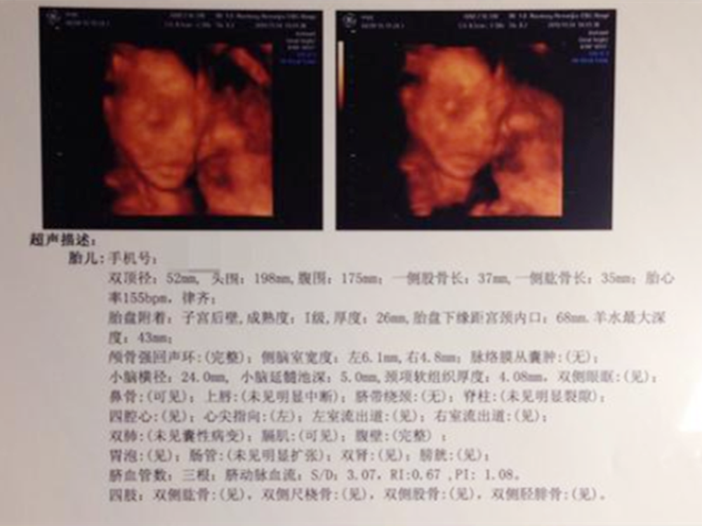 武汉2021找代孕_武汉国内可以做供卵试管吗_孕期做四维彩超，检查单上这几点能